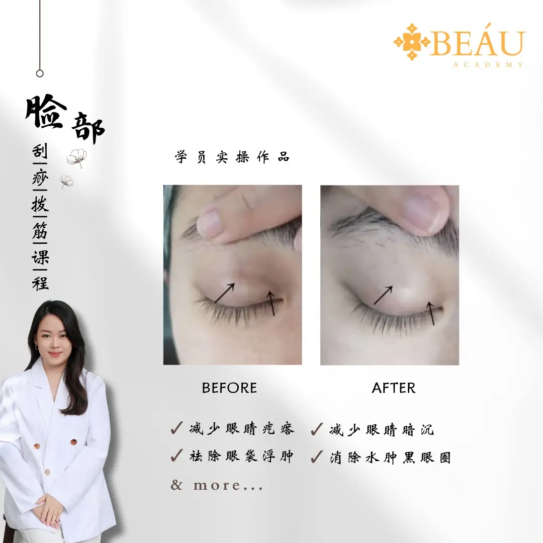 脸部理疗学员实操对比图（眼部精修）。单次疗程即可有效减少眼睛疲劳、消除水肿型黑眼圈并祛除眼袋浮肿。通过真实的视觉反馈，向潜在顾客直观证明眼部经络疏通的立竿见影之效。