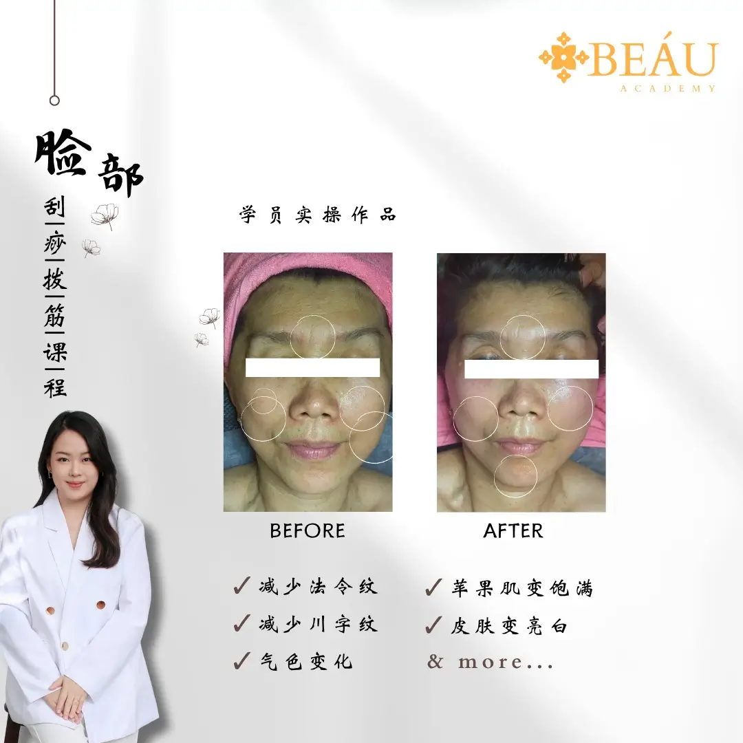 脸部刮痧抗衰学员实操对比图（抚平细纹）。精准疏通面部经络后，顾客法令纹与川字纹显著淡化，苹果肌恢复饱满，肤色整体亮白。用最真实的案例展示技术价值，彻底打消学员对疗效的顾虑，促成最终报名。